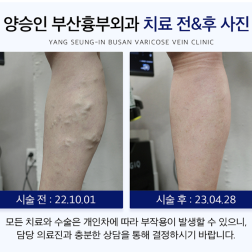 하지정맥류, 검사와 비용이 궁금하다면 ?
