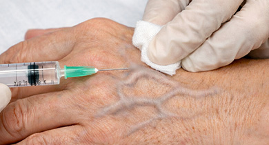 Sclerotherapy