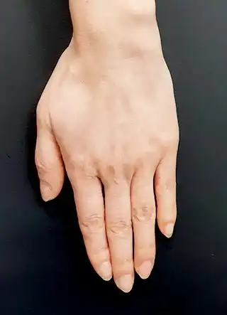 손등정맥 치료 후