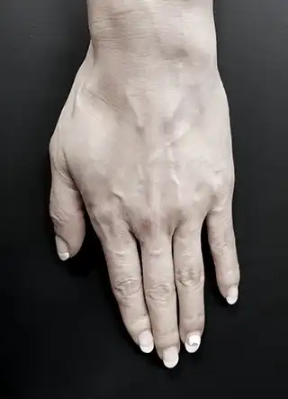 손등정맥 치료 전